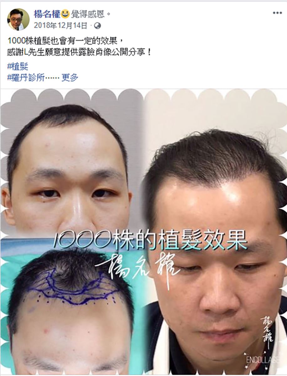 植髮,禿頭,雄性禿,楊氏羅丹